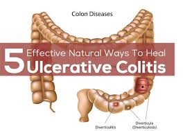 Ulcerative Colitis Diet 5 Effective Natural Ways To Heal Ulcerative Colitis Ulcerative Colitis Diet Colitis Diet Ulcerative Colitis Recipes