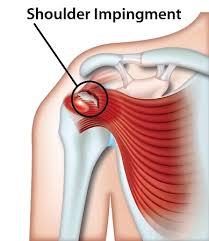 He also gave structure to the diagnostic process. Shoulder Impingement All Products Are Discounted Cheaper Than Retail Price Free Delivery Returns Off 79