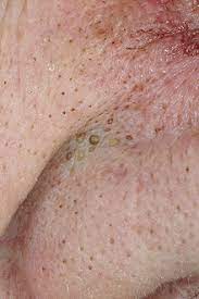 However, in the early stages, this condition causes the terminal ducts to. Comedo Wikipedia