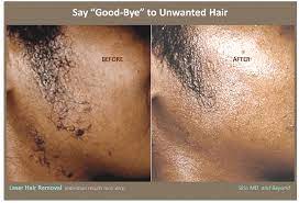 How much does laser hair removal cost? Laser Hair Removal Plano Tx Frisco Tx