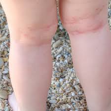 Image result for Allergic Triad