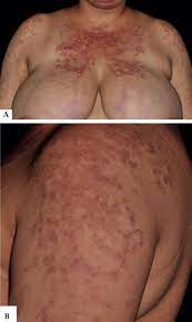 Lupus is an autoimmune disease — meaning the immune system doesn't function properly and attacks a person's own body by mistake — and it affects multiple organs throughout the body. Rituximab In The Treatment Of Extensive And Refractory Subacute Cutaneous Lupus Erythematosus