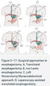 However, in the late postoperative period, disease recurrence becomes an increasing concern. Different Approaches For General Surgery Discussions Facebook