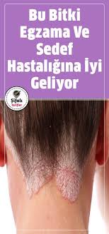 Bu Bitki Egzama Ve Sedef Hastaligina Iyi Geliyor Nemli Her Ortamda Yeti Bitki Bu Egzama Geliyor Hastaligina Iyi Nemli Dogal Saglik Bitki Saglik