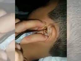 Membuang tahi telinga keras dan berkrim | reupload. Video Lelaki Cina Ini Buang Tahi Telinga Keras Tanpa Pesakit Rasa Sakit Jadi Perhatian Netizen