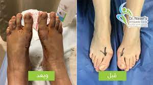 إصابات القدم والكاحل drnasef