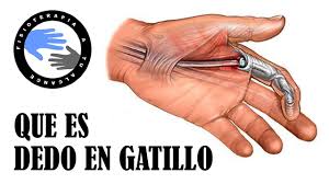 Dedo En Gatillo O Resorte Que Es Y Porque Se Produce Youtube