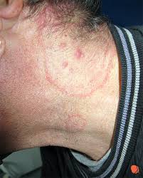 Tinea corporis is a superficial dermatophyte fungal infection of the glabrous skin. Micoze Cutanate Superficiale Mivaderm Cabinet Dermatologie Dr Virginia ChiÈ›u