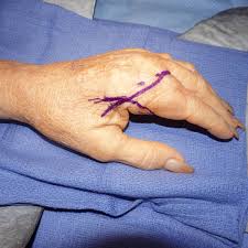 Image result for Elson Extensor Tendon Test