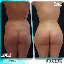 A valid credit card number is required at the time of booking your consultation. Fat Transfer To Hips Procedure Recovery And The Price