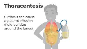 Image result for Thoracentesis