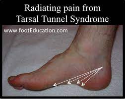 Tarsal Tunnel Syndrome Footeducation