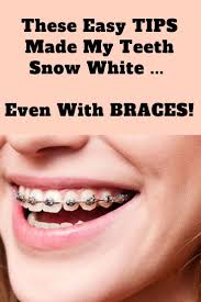 How to whiten teeth with braces? Pin On Teeth Whitening Tips For Nov Dec 2018