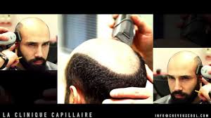 Découvrez notre sélection de survêtements homme chez asos. Remplacement Capillaire Le Centre De Remplacement Capillaire De Restauration Capillaire De Greffe De Cheveux Non Chirurgicale De Transplantation De Cheveux Non Chirurgicale De Protheses Capillaires De Volumateurs Cheveux De Perruque Pour
