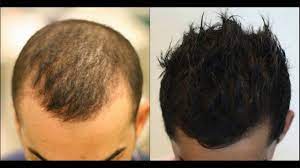 It is safe and minimally invasive. Heal The Hair Loss With Prp Hair Treatment Article Ritz
