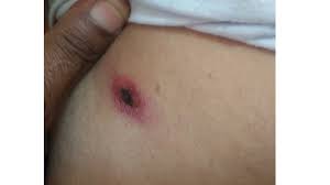 Image result for Trombicula autumnalis bites