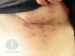 Image result for zoster under breasts