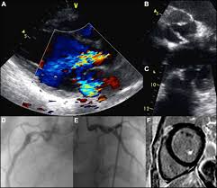 Radiation Induced Cardiac Valve Disease The American Journal Of Medicine