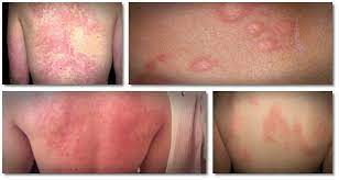 How To Cure Hives Fast | How “Natural Urticaria Relief” Helps People Get  Healthy Skin – Healthreviewcenter