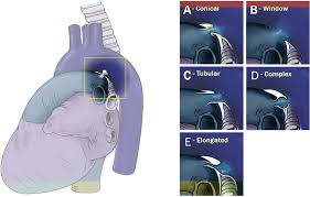 | cardiac catheterization procedure to close a patent ductus arteriosus (pda). Clinical Outcomes After Percutaneous Patent Ductus Arteriosus Closure In Adults Canadian Journal Of Cardiology