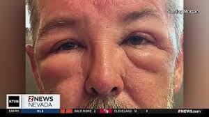 8/1/24 Health Watch: Sterling's Sunburn