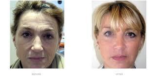Or swirl them together for a quick easy glow. How To Get A Cheek Lift With Fillers The Cosmetic Skin Clinic