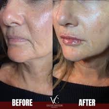 Subtle. Soft. Stunning. ✨ Tox refresh + ½ syringe Juvéderm Ultra XC =  chef's kiss 💉 #SquareOneAesthetics #TallahasseeFL #TallyAesthetics  #AestheticInjector #MedSpaMagic #JuvédermUltraXC #NaturalAesthetics  #FillerResults #LipFiller #BeautyTok #GlowUp ...