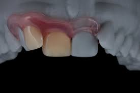 Flexible partial dentures are also easier to manufacture, having less components meaning they can be made in a shorter period of time. Valplast Flexible Dentures Bremadent Dental Laboratory