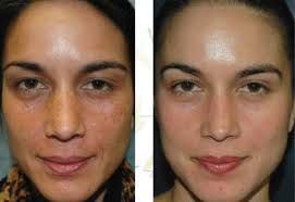 Here is a skin care regimen you can follow right after. Chemical Peels Medical Grade Tca Gambhir Cosmetic Medicine