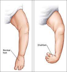 Clubfoot, otherwise known as talipes equinovarus, is a deformity affecting the foot and the ankle wherein it is turned inward and downward. Club Foot Treatment Surgery Cost In Lagos Find The Best Surgeons Reviews And Book Appointment Africa Infoline