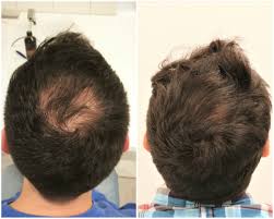 We know this can feel like a very long time when you want to. Hairboost Results Prp Finasteride In Lotion Minoxidil