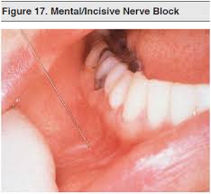 Image result for Periapical Block