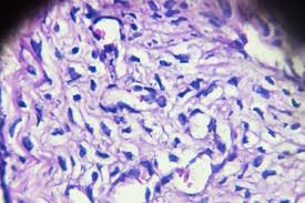 Cervical cancer happens when the cells of your cervix change. Pap Tests May Hold Biomarkers Ahead Of Ovarian Cancer Diagnosis Cancer Therapy Advisor