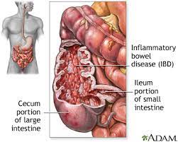 Crohn S Disease Symptoms And Causes