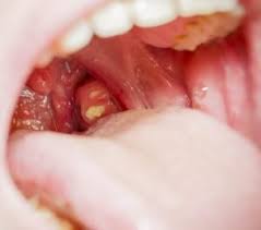 Mandelentzündung (tonsillitis, akute tonsillitis, angina tonsillaris, chronische mandelentzündung, chronische tonsillitis, tonsillitis chronica). Mandelentzundung Beim Kind Symptome Ursachen Und Behandlung