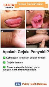 Sebagaimana namanya, penyakit hfm melibatkan tangan, kaki dan mulut seseorang pesakit. Fakta Penyakit Kaki Jabatan Kesihatan Negeri Perak Facebook