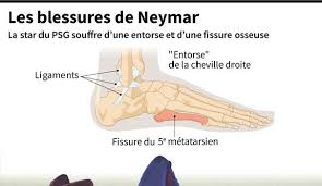 30 janvier 2019 à 18h19. La Fissure Du Cinquieme Metatarsien De Neymar Mais Qu Est Ce Que C Est L Express
