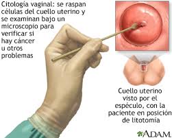 Cáncer de garganta síntomas y causas. Cancer Cervical Medlineplus Enciclopedia Medica