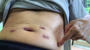 For open surgery, your recovery time can be between 6 and 8 weeks. Radical Prostatectomy Recovery Six Days Post Surgery What I Learned Youtube