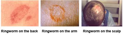 Ringworm is a common skin infection that is caused by a fungus. Symptoms Of Ringworm Ringworm Types Of Diseases Fungal Diseases Cdc