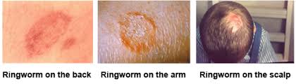 Symptoms Of Ringworm Ringworm Types Of Diseases Fungal Diseases Cdc Scalp ringworm (tinea capitis) is a very common fungal infection among children throughout the world. symptoms of ringworm ringworm types