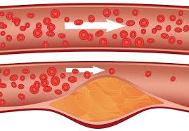 7 Sinais Perigosos De Arterias Obstruidas Que Nao Podemos Ignorar Incrivel