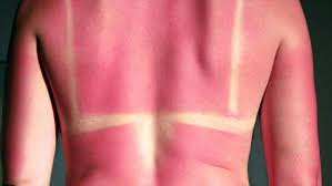 Image result for Sunburn