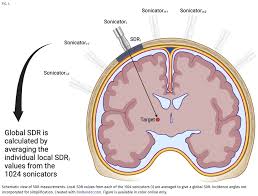 Image result for Thalamotomy