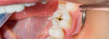 Maybe you would like to learn more about one of these? Karies Symptome Ursache Behandlung Mooci