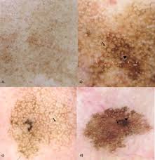 Image result for Solar Lentigo