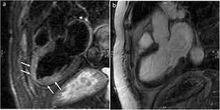 Myokarditis (herzmuskelentzündung) ist eine sammelbezeichnung für entzündliche erkrankungen des herzmuskels mit unterschiedlichen ursachen. Cardiovascular Disease In Women Insights From Magnetic Resonance Imaging Journal Of Cardiovascular Magnetic Resonance Full Text
