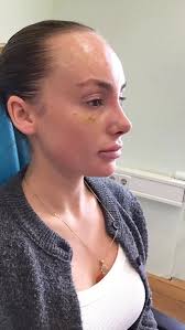 10 Tage nach Rhinoplasty #berlin #nasenkorrektur #rhinoplasty #تجميل  #اكسبلور_فولو #nosejob #hno #تجميل_الأنف #explorepage