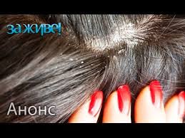 как избавится от перхоти в домашних условиях за 1 день Kak Izbavitsya Ot Perhoti Navsegda V Domashnih Usloviyah Za Zhive Anons Smotrite 31 10 Youtube