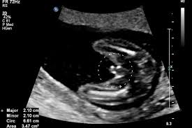 Pin On Ultrasound And Babies